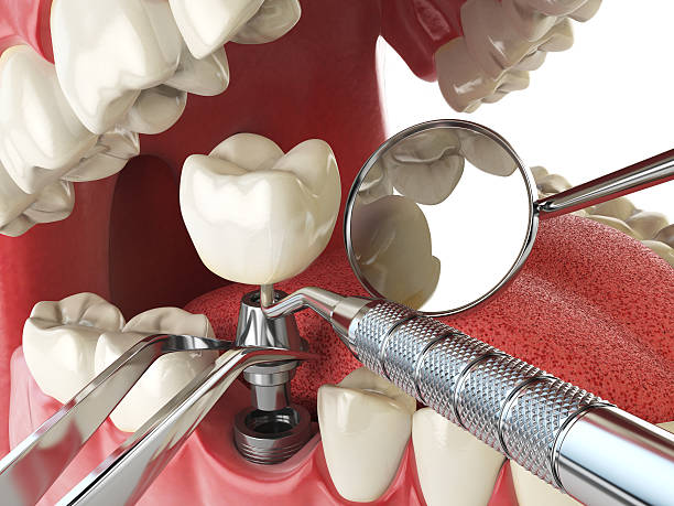Best Lost Filling or Crown Replacement in Pixley, CA